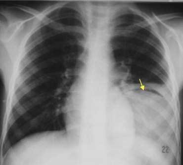 The pulmonary meniscus sign (arrow): crescent-shaped inclusion of air surrounded by consolidated lung tissue As the air