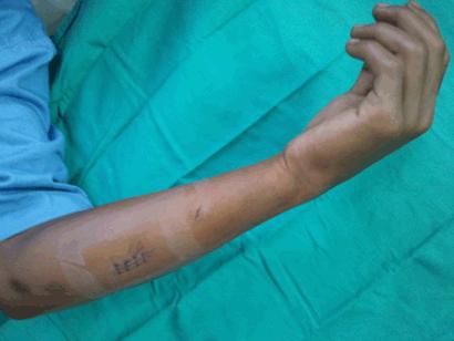 His wound was dressed and he was administered an anti-tetanus toxoid (ATT) injection prior to referral.