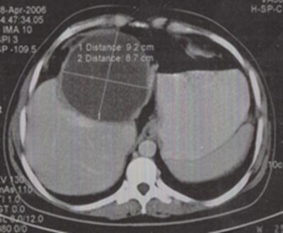 Figure 3 Figure 5 At laparotomy the subhepatic cyst was identified as huge ovarian cyst arising from right ovary with one and a half turn around its pedicle (Fig. 4).