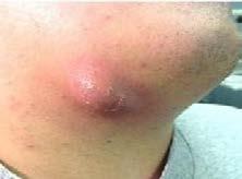 area of approximately 75 cm 2 Examples include: Major cutaneous abscesses Wound infection