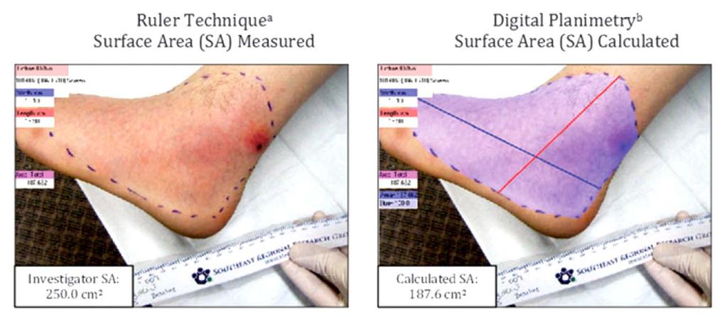 Two Methods to Measure the Lesion Size Ruler Technique (RT) and Digital Planimetry (DP) RT: the longest head-to-toe length and the greatest perpendicular width of a lesion; accurate for rectangular
