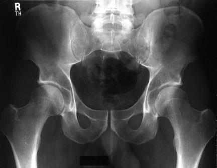 In patients with sacroiliitis, the most commonly observed abnormalities