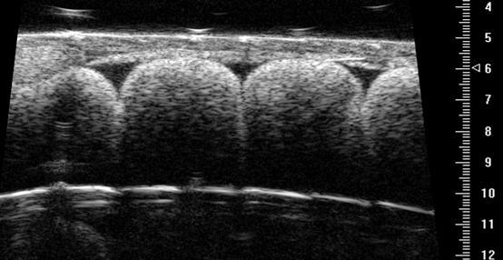 13 Figure 7: Ultrasonography image of enlarged follicles