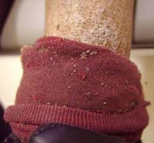 Pediculosis symptoms: hardened, pigmented skin. Body lice visible on sock. (web.stanford.
