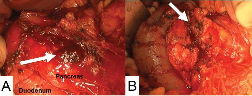 Figure 2. (). The min rnch of the gstroduodenl rtery showing rupture nd leeding t the pncretic hed (rrow). (). The pncres, including the min pncretic duct, ws ruptured t the right mrgin of the portl vein (rrow).