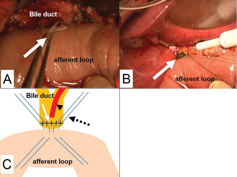 (c). Schem. Arrow: sutured ile duct stump. Arrow hed: dringe tue (in the ile duct). Dotted-line rrow: fixed ile duct stump nd jejunum posterior wll.