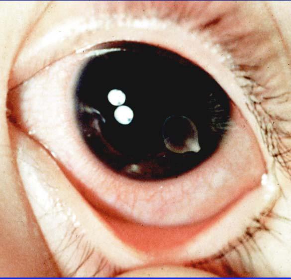 Cysticercus floating freely in anterior chamber