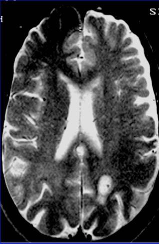 Neuro-cysticercosis T1 weighted T1