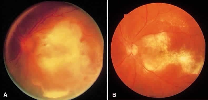 New Treatment Modalities for Ocular Complications of Endocarditis http://dx.doi.org/10.5772/56537 115 standard of care for the acute management of endogenous uveitis in the U.S.