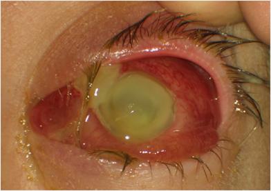 New Treatment Modalities for Ocular Complications of Endocarditis http://dx.doi.