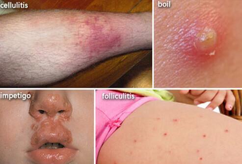 skin infection