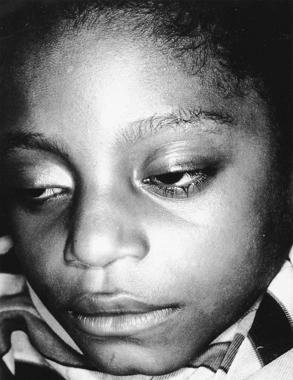 Death adder bites 29 Figure 4. Ptosis in a 5-year-old girl bitten 4 h previously by a death adder at Baitarata, Madang Province, Papau New Guinea.