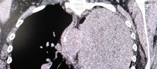 At the moment of presentation, the patient was diagnosed with totally calcified splenic hydatid cyst.