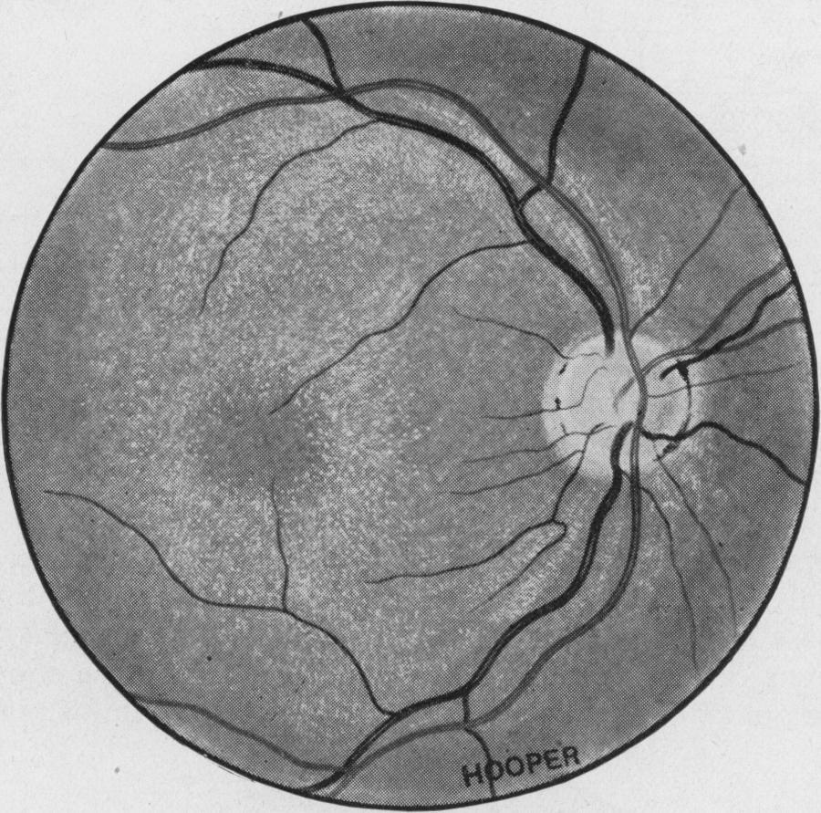 FUNDUS REFLEXES AND RETINITIS PIGMENTOSA Case Report A girl aged 9 years first attended the Belgrave Hospital for Children in January, 1949, as her school-mistress suspected that her vision was