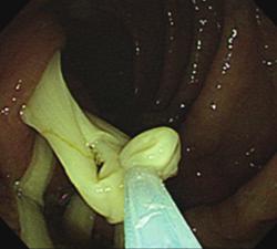 Kim and Chung: Taenia asiatica infection diagnosed by colonoscopy 67 Fig. 3.