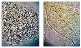 RESULTS AND DISCUSSIONS In the positive skin scraping samples, on direct microscopy (KOH), fungal elements as networks of branching fungal hyphae were observed (Figure 2).