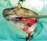 Surgical removal of worms from the right atrium and orifice of the tricuspid valve can be accomplished using light sedation (may not be necessary), local anesthesia, and either a rigid or