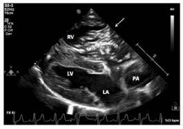 Pulmonary Arterial Infections The main pulmonary artery and lobar branches can be accessed with flexible alligator forceps aided by fluoroscopic guidance.
