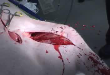 Blood spurting out of a wound Bleeding Control