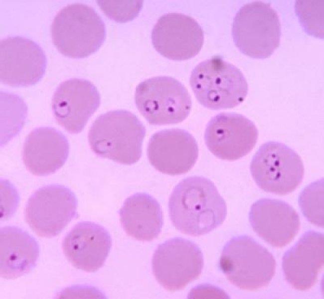 Plasmodium falciparum causes parasitized red cells to produce numerous projecting knobs that adhere to the endothelial lining of blood vessels, with resulting obstruction, thrombosis, and local