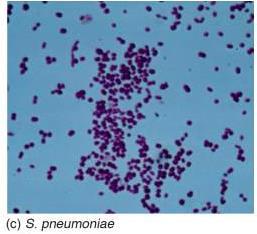 Pneumonia Pneumonia isan acute infection of the parenchyma of the lung, caused by bacteria, fungi,