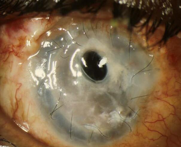 Excisional keratoplasty Early surgical intervention (2-3 weeks) in deteriorating cases or extension into anterior chamber or sclera 1. 2mm clearance 2. Remove iris and lens as required 3.