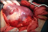 spleen en bloc. (Fig.2) Post Splenectomy a thorough peritoneal lavage with hypertonic saline solution (15%NaCl) was given to eliminate any potential contamination.