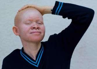 «My dream is to be a lawyer so that I can protect people with albinism, those who have been attacked, and those who are in danger.