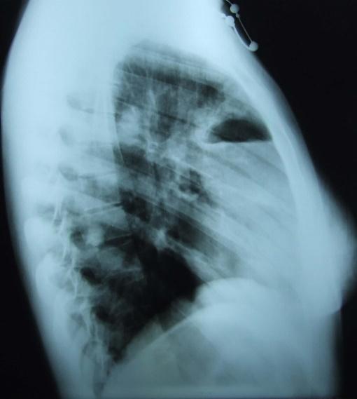 Materials and Methods A 25 year-old girl was referred to our unit with non-productive cough, dull chest pain and fever for the past few weeks. Examination revealed a pacient with tachypnea and fever.
