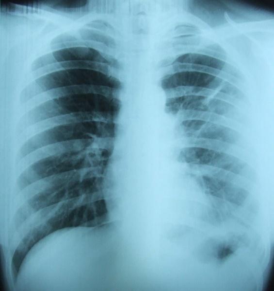 767 Figure 3 Chest CT showing multiple lesions, especially in the left