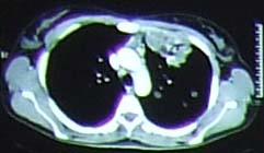 in the left lung, chest window Fiberbronchoscopy was also performed and