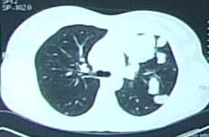 suppurated cystic mass placed in the anterior segment of the left upper