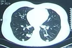 found in the parenchyma of the left lung with sizes between 0.