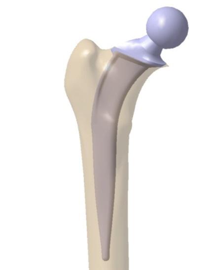 it is presented within the reconstructed model of the femur). [α ] Min. safety Life of failure factor x 10 8 cycles 15 1.08 0.9 16 1.18 1.3 17 1.34 1.5 18 1.67 1.7 19 1.98 1.9 20 2.01 2.3 Table 2.