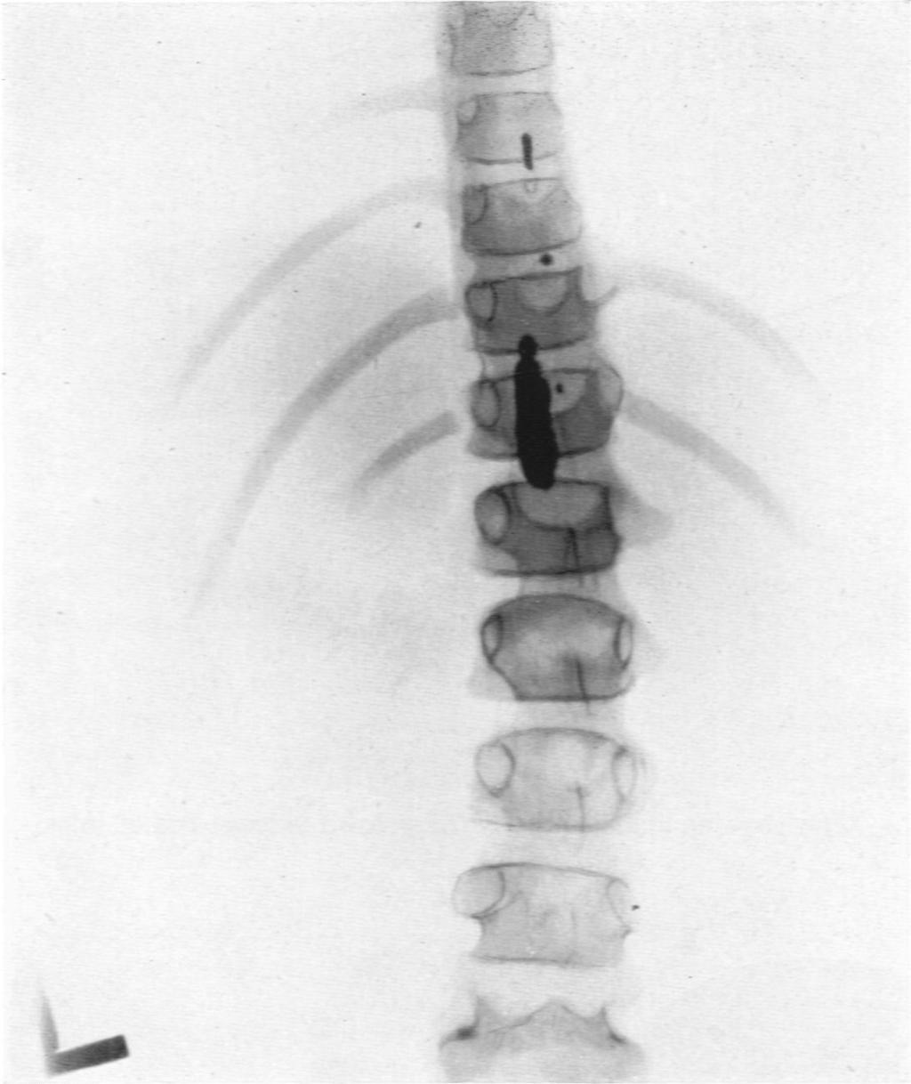 HYDATID CYST OF SPINAL CANAL Both the external and internal surfaces were perfectly smooth and there were no ingrowths.