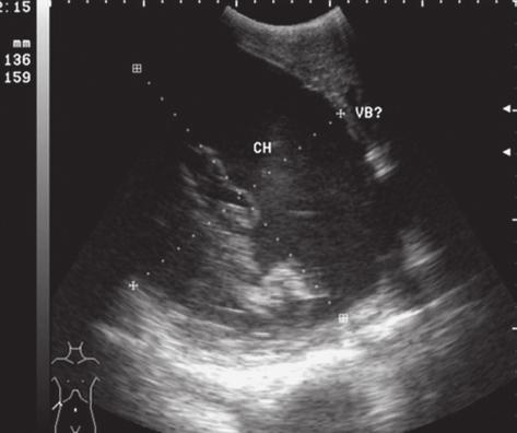 datid liver cyst. In all three cases the patients followed chemotherapy with Albendazole and ultrasonography was used for diagnosis and monitoring. Case no. 1 Patient B.