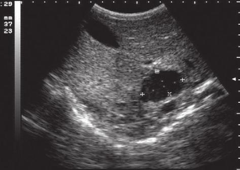 The liver ultrasound revealed three cystic images with an aspect suggestive for hydatic cyst.
