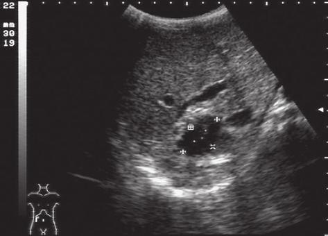 342 Horaţiu Gocan et al The role of ultrasonography in Albendazole treatment Albendazole therapy favorably influenced the outcome of this patient.