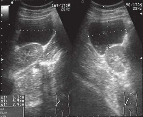 Ultrasound revealed multiple liver cysts which resulted in raising the suspicion of hidatid liver cysts.