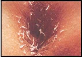 Pinworms AKA: seatworms or threadworms Most common in US 42 million people Mostly children aged 5-14 years Commonly