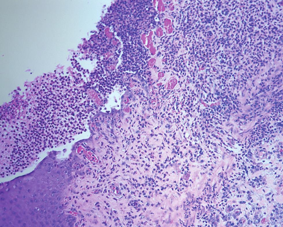 Figure 4: Eyelid of an affected goat with ulceration of the squamous epithelium and infiltration of mainly neutrophils. 200. H&E. Figure 5: Eyelid of an affected goat.