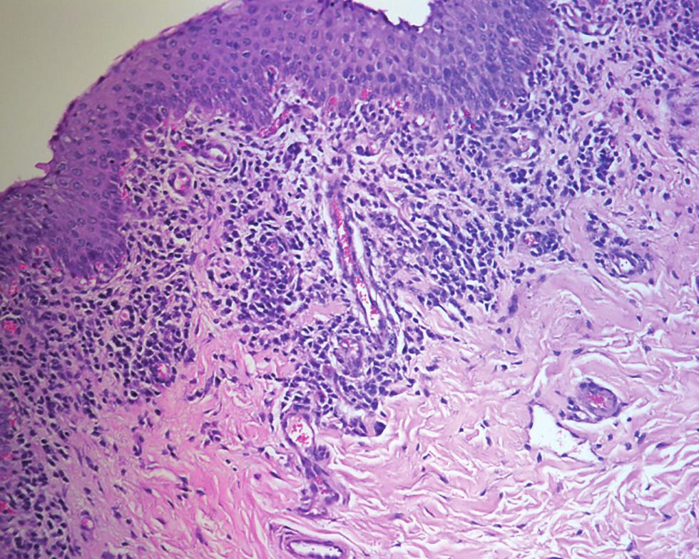 epithelium of the cornea and in addition to a diffuse infiltration of inflammatory cells mainly neutrophils into the underlying stroma (Figure 3).