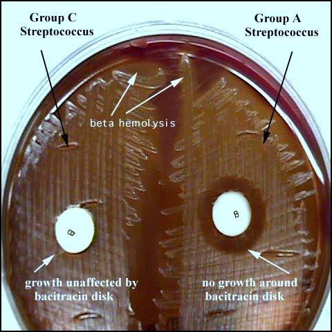 B -hemolytic :Group B streptococci- S. agalactiae: Normal flora of female vaginal tract and cause neonatal meningitis.