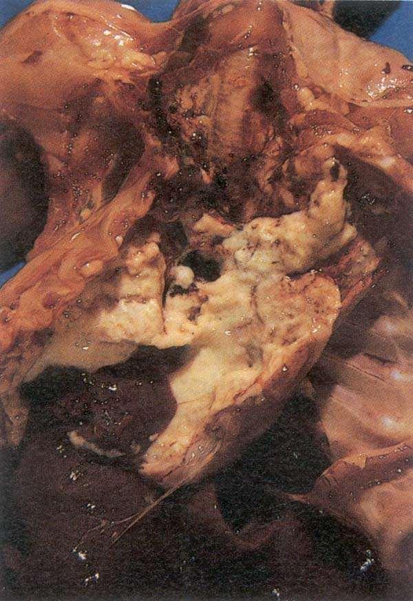 2. Enlarged body organs 3. Bluish discoloration of body tissues Abscesses: Walled off abscesses containing white creamy cheesy pus. Eye and middle ear infection: 1.