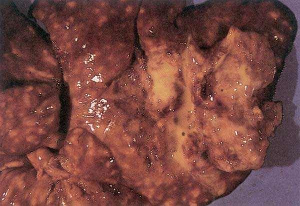 Fig. 213: Coccidiosis. Enlarged liver with multifocal greyish-white coalescing lesions and yellowish liquid pus caused by E. stidae.