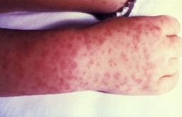 fever onset) 10% of cases rash is absent or atypical Macules (pink in coloration) Start on wrists/forearms/ankles-spreads centrally 1 to 4mm in size Palms & soles characteristic Petechiae Develops 6