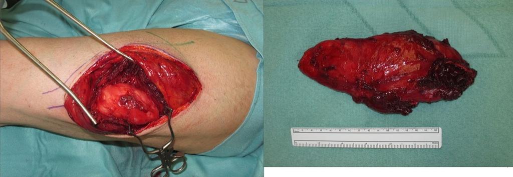 Fig. 2 Situs during resection of the encapsulated mass (a) and the resected mass (b), which weighed 211 g and was 17 7.5 2.
