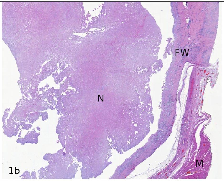 collapsed degenerated inner germinal epithelial layer (GL).