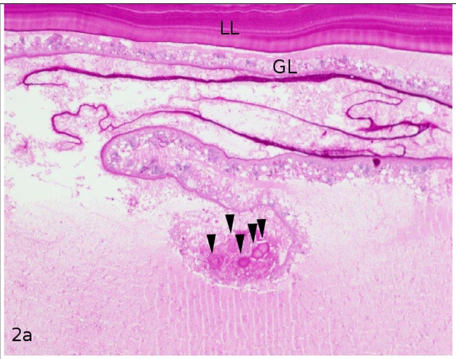 2a Hematoxylin and eosin stain, 400 magnification with typical section through the cyst wall layers of cystic Echinococcosis showing parts of the laminated layer (LL) and the inner germinal