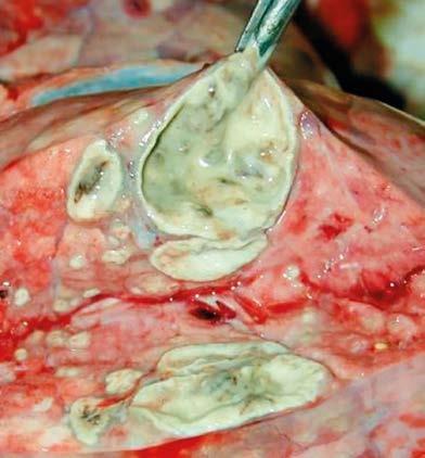 Lungs Abscess Presence of one or more discrete abscesses.